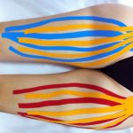 Tudo o que você quer saber sobre o linfedema