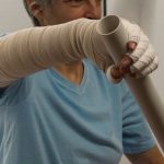 Terapia Ocupacional no tratamento do linfedema