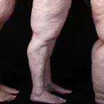limpedema