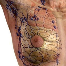 Instalação do Linfedema secundário pós câncer